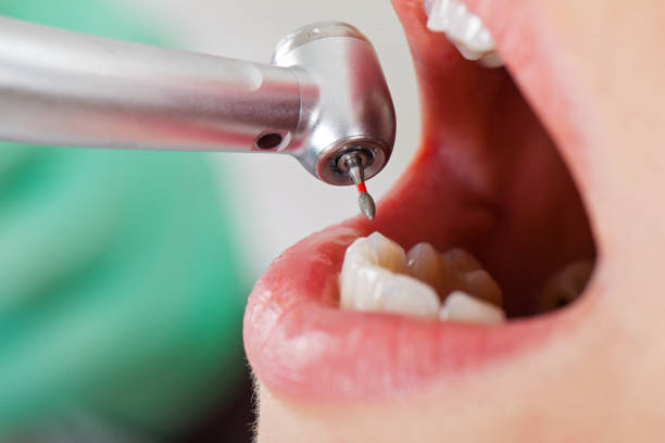 Best Chipped Tooth Repair Near Me  in Orient, NY